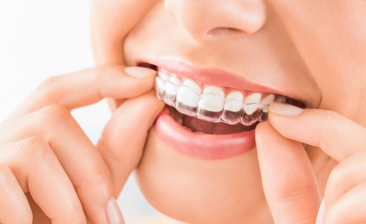 Clear Aligners In J P Nagar